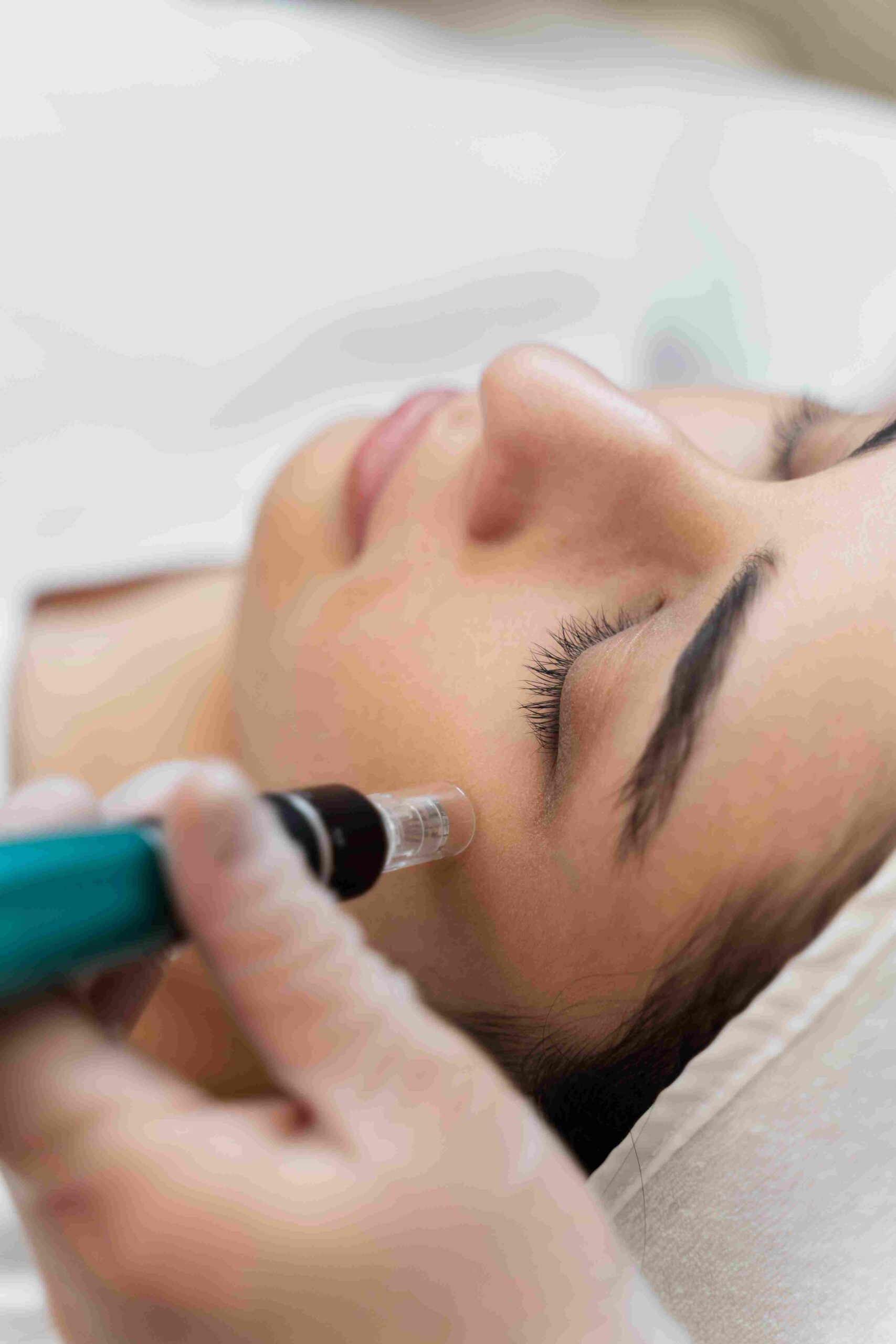 Dermapen facial y corporal en Oviedo - Carla Alvarez Estetica Avanzada